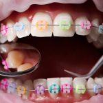 Macro snapshot of open mouth, teeth, ceramic braces with colorful rubber bands on them, latex cheek retractor on lips. Dentist checking teeth with mirror and dental explorer. Concept of orthodontics